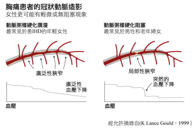 coronary Angiograms for pts with chest pain